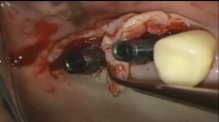 Advanced surgical techniques for flap management: Palacci technique